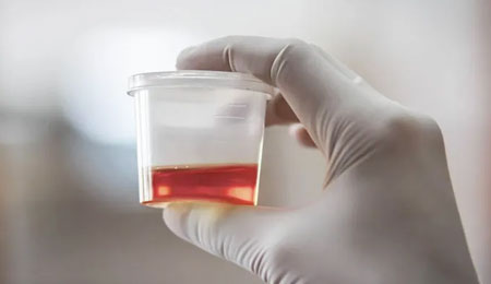 Blood in the Urine